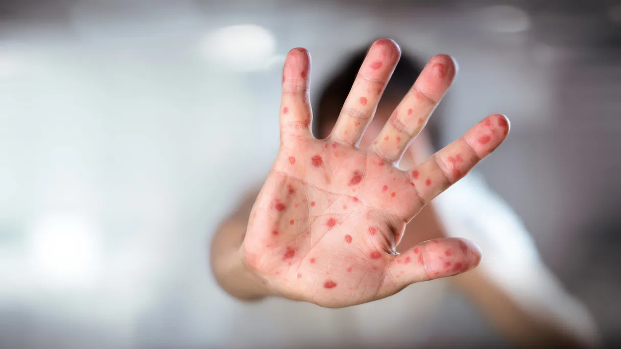 Après sa transformation en épidémie, le Maroc explique les causes de la propagation de la rougeole